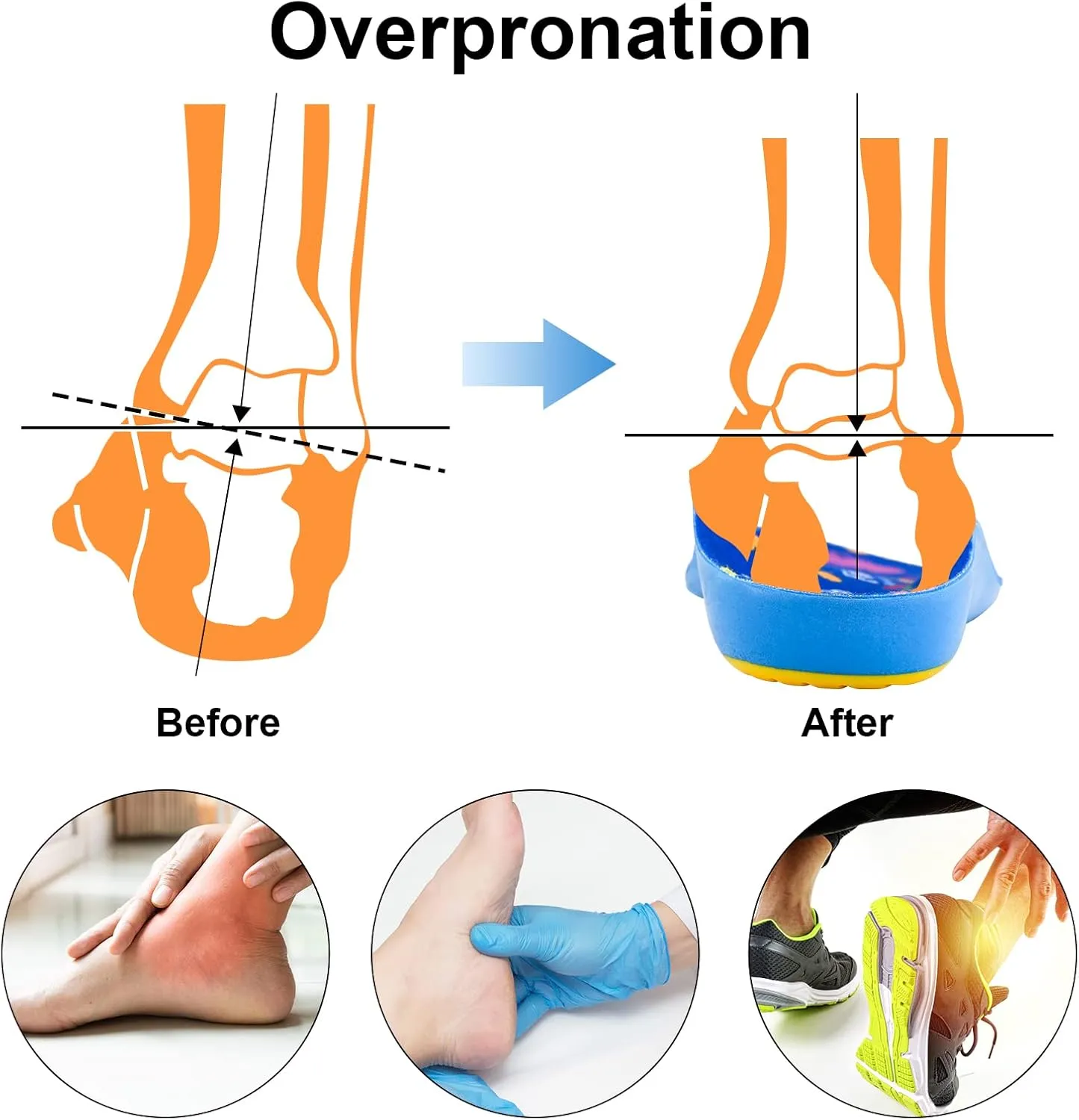 Kids Arch Support Orthotics Over-Pronation Plantar Fasciitis Flat Feet PU Foam Inserts Relieve Foot Back Hip Leg and Knee Pain, Gel Cushion for Heel Pain